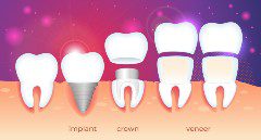 Having Veneers Placed 