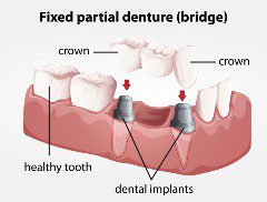 porcelain fixed bridges