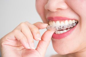 Invisalign and its Benefits Compared to Braces