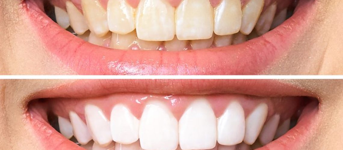 teeth whitening